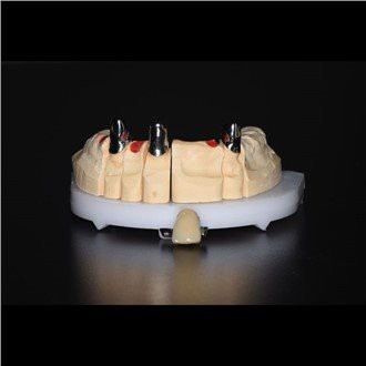 Telescopic Partial Dentures