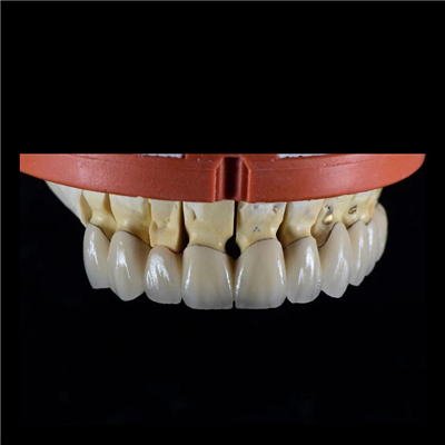 PFM Ceramic Crowns